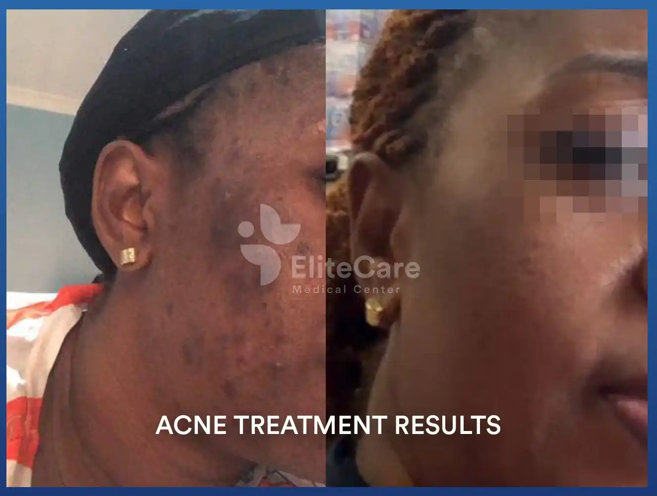 Acne-2