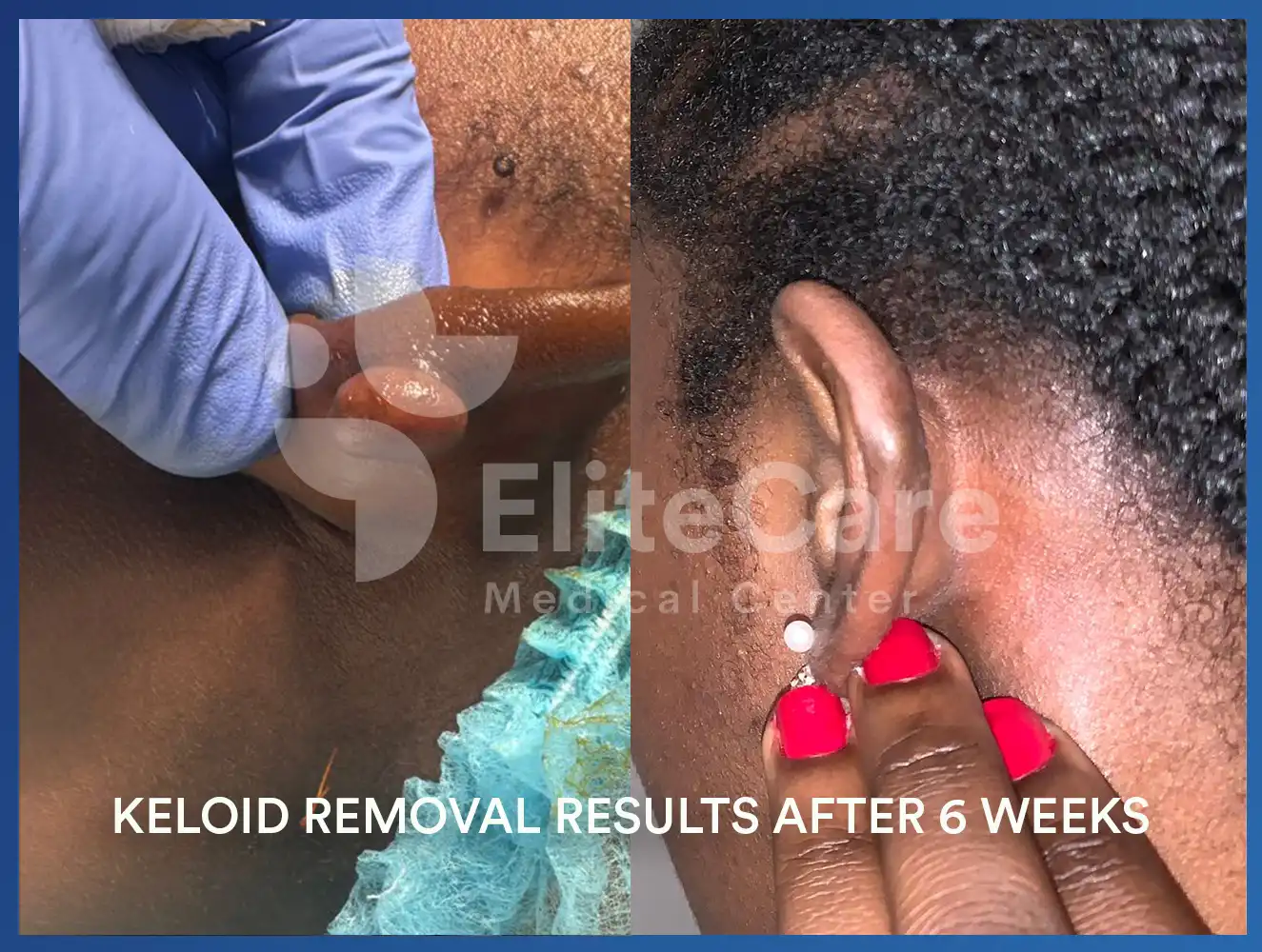 Keloid-Treatment-2