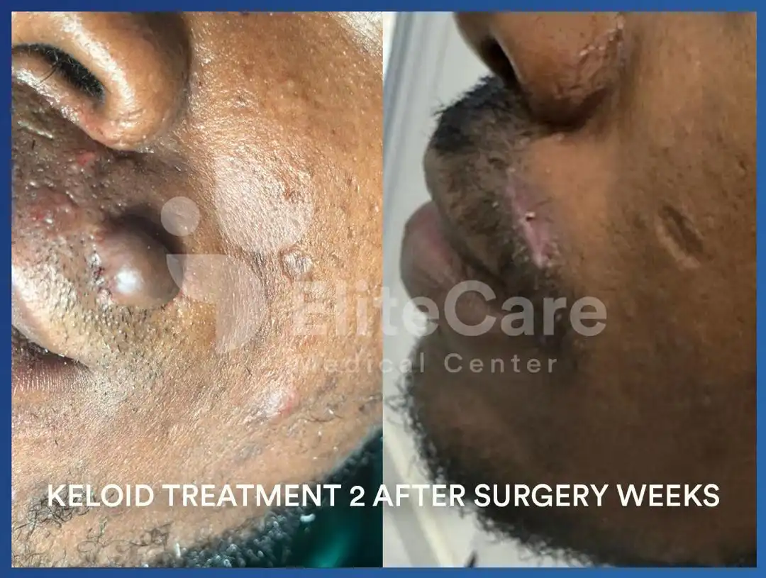 Keloid3