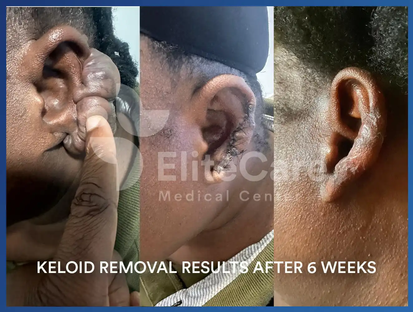 Keloid_