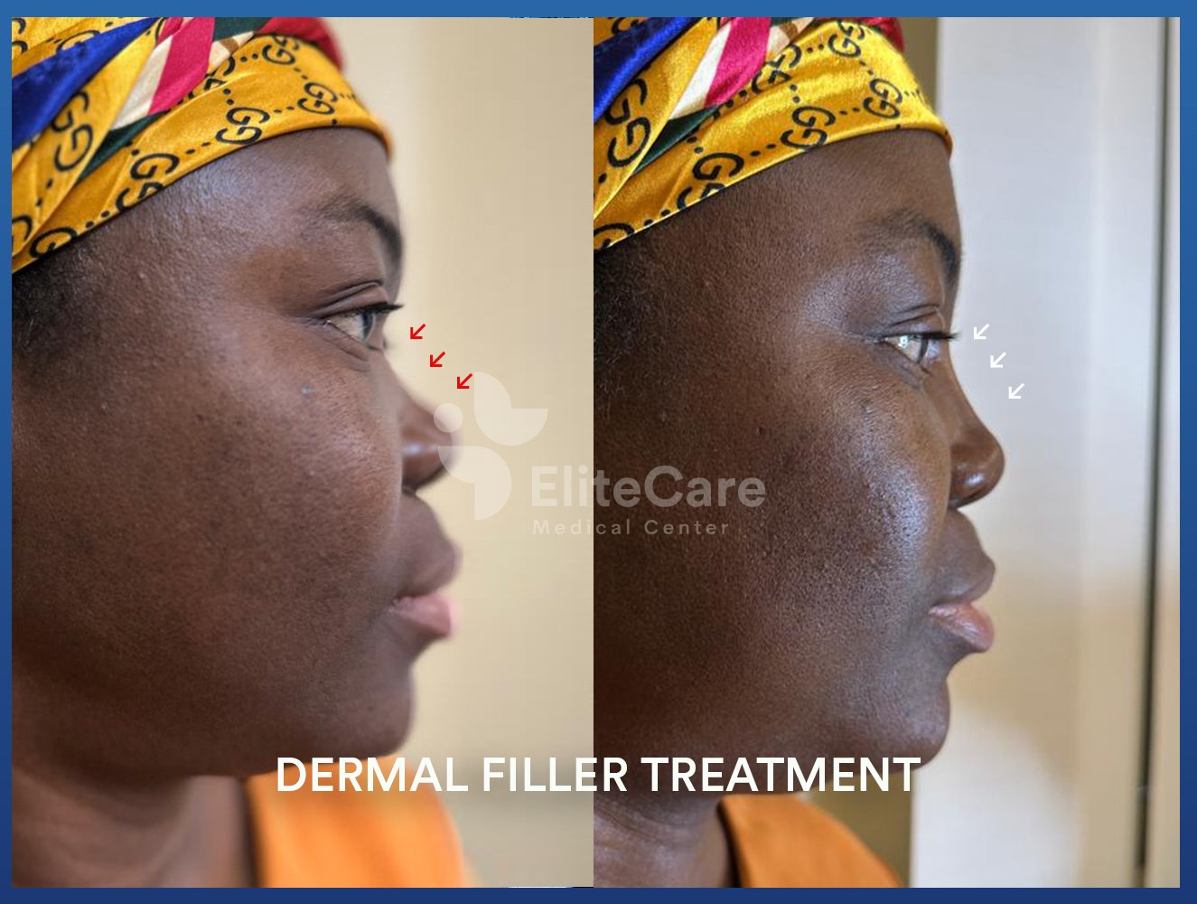 Dermal_Filler